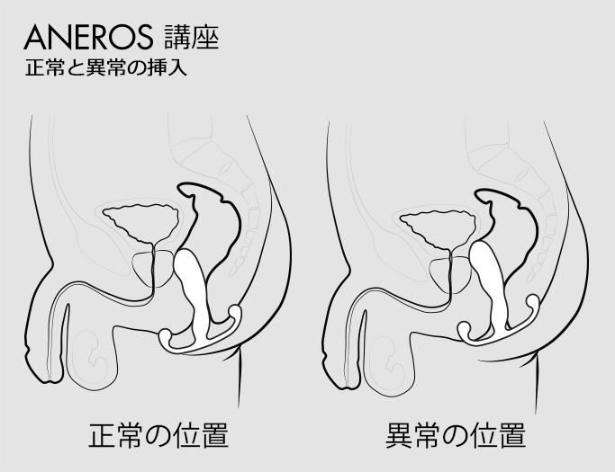 正しい挿入と無理な挿入を比較したアネロス公式の図