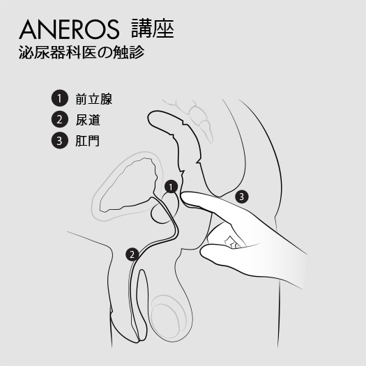 泌尿器科医による前立腺の触診検査を示すアネロス公式の図
